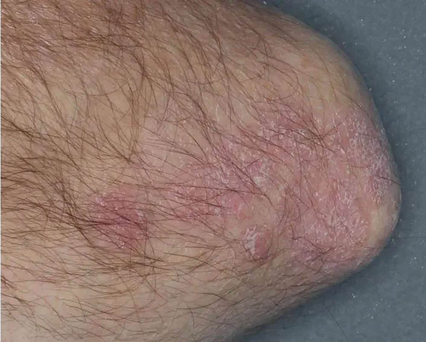 Elbow - Week 2 IGA = 3