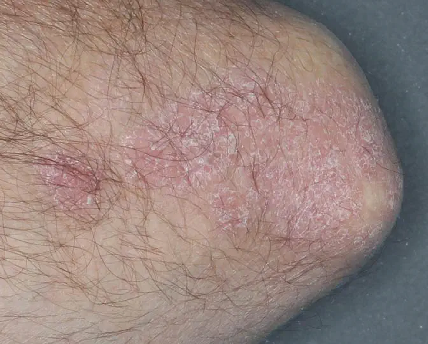 Elbow - Week 4 IGA = 2
