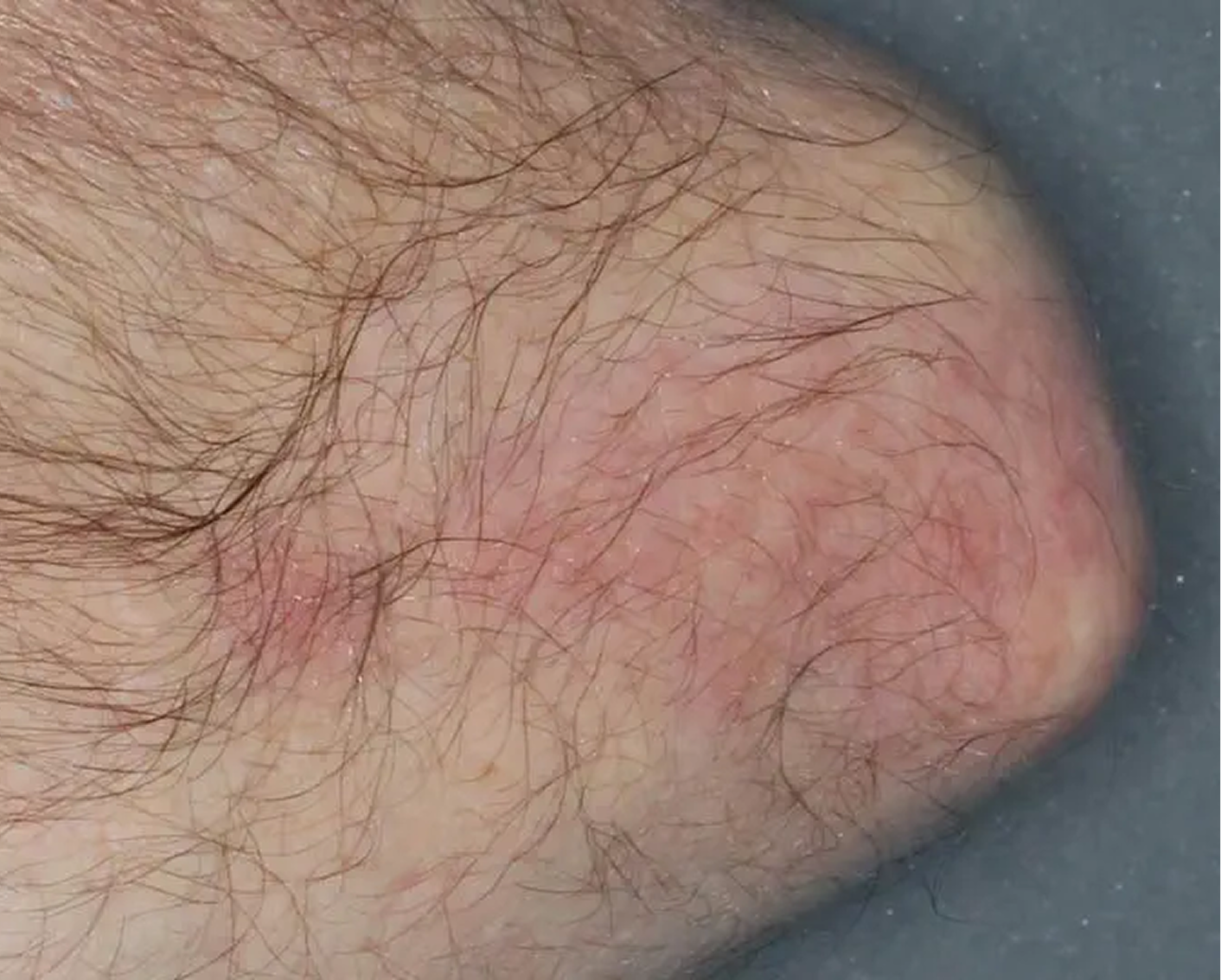 Elbow - Week 6 IGA = 2