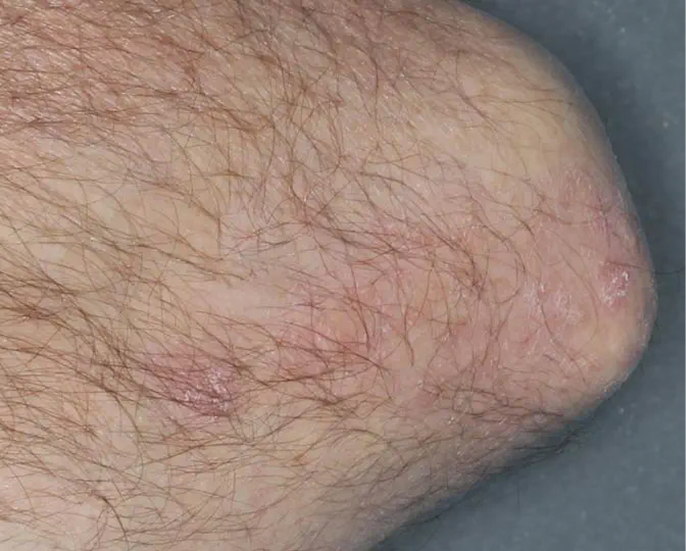 Elbow - Week 8 IGA = 1