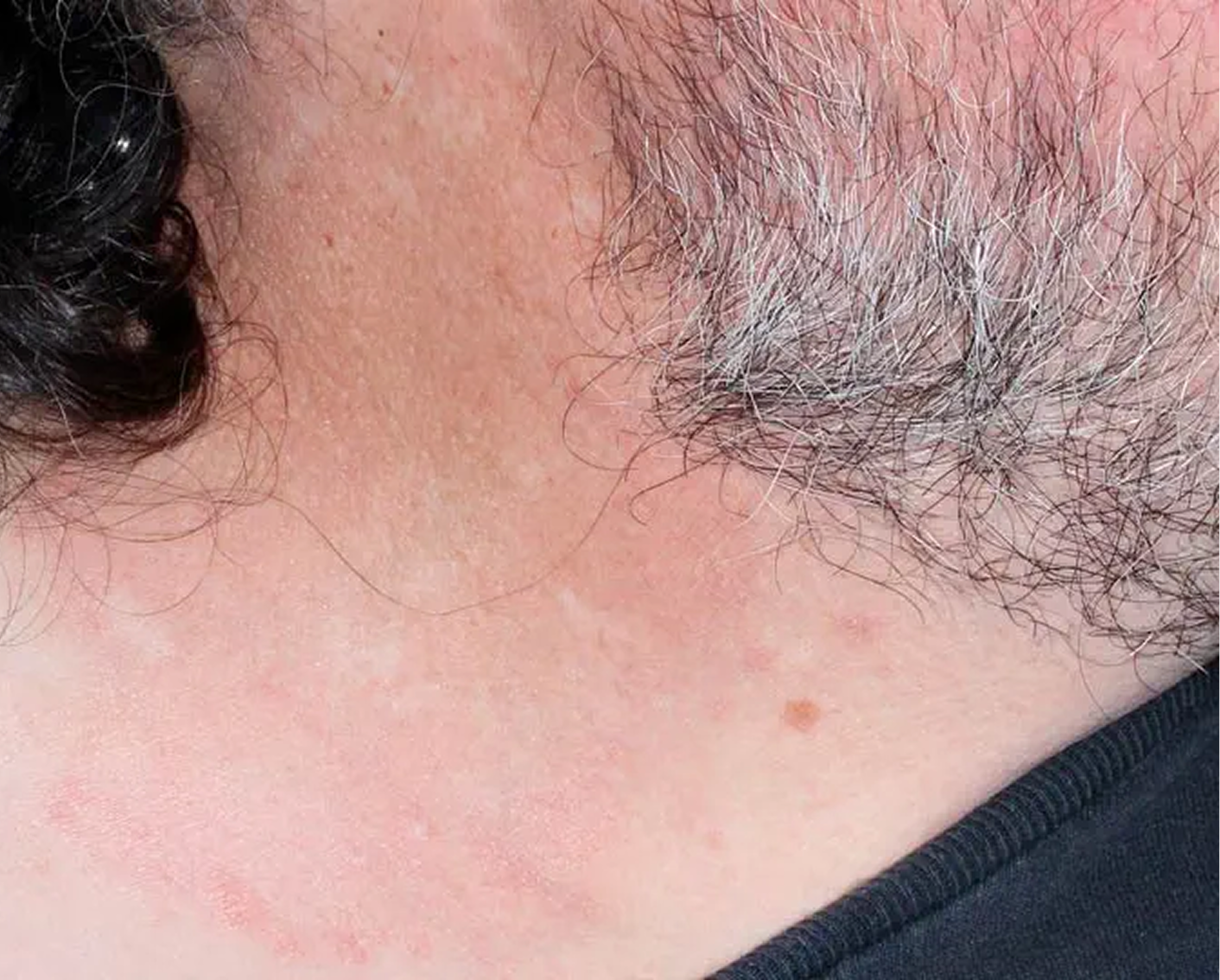 Face & Neck - Week 4 IGA = 1