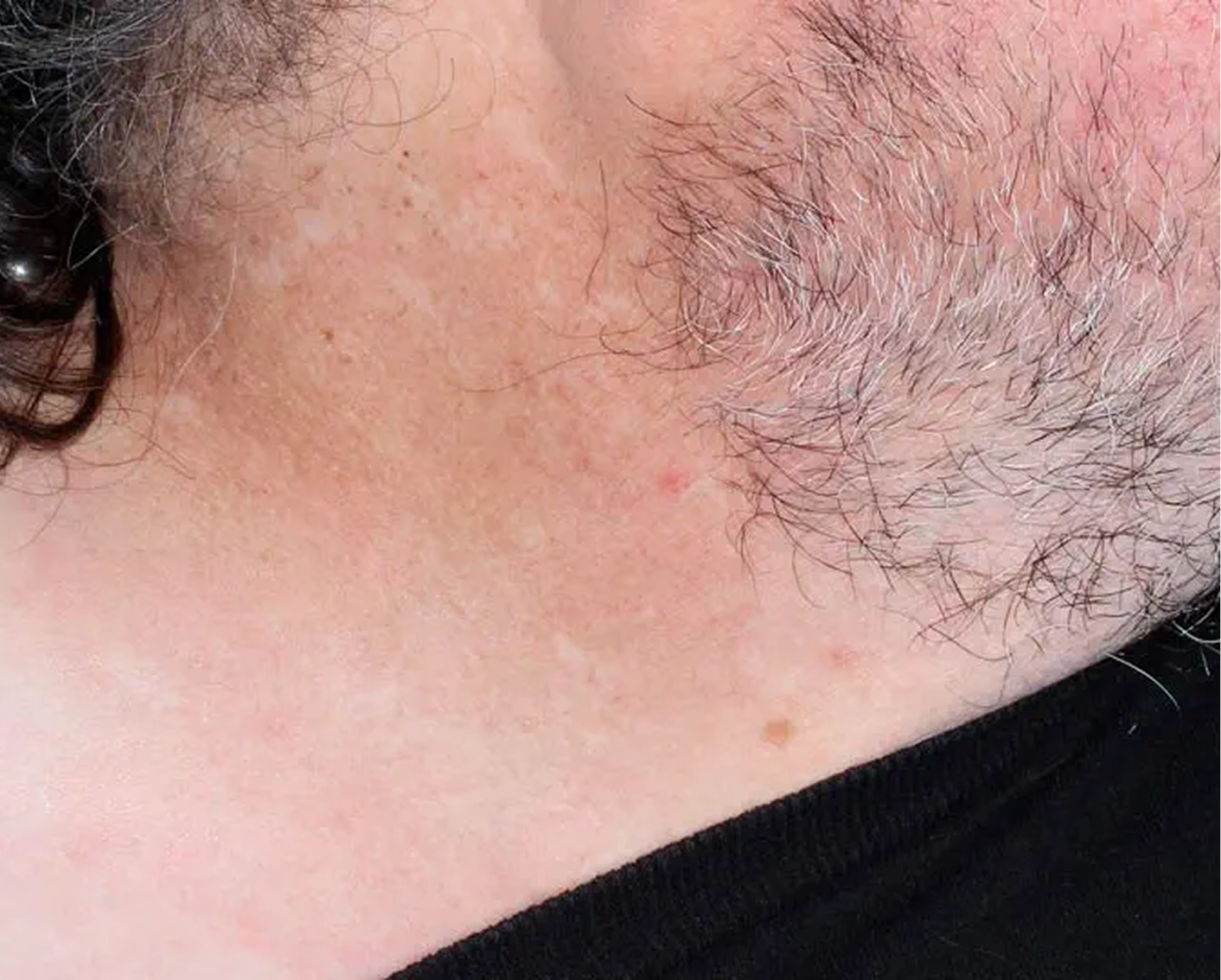 Face & Neck - Week 6 IGA = 0