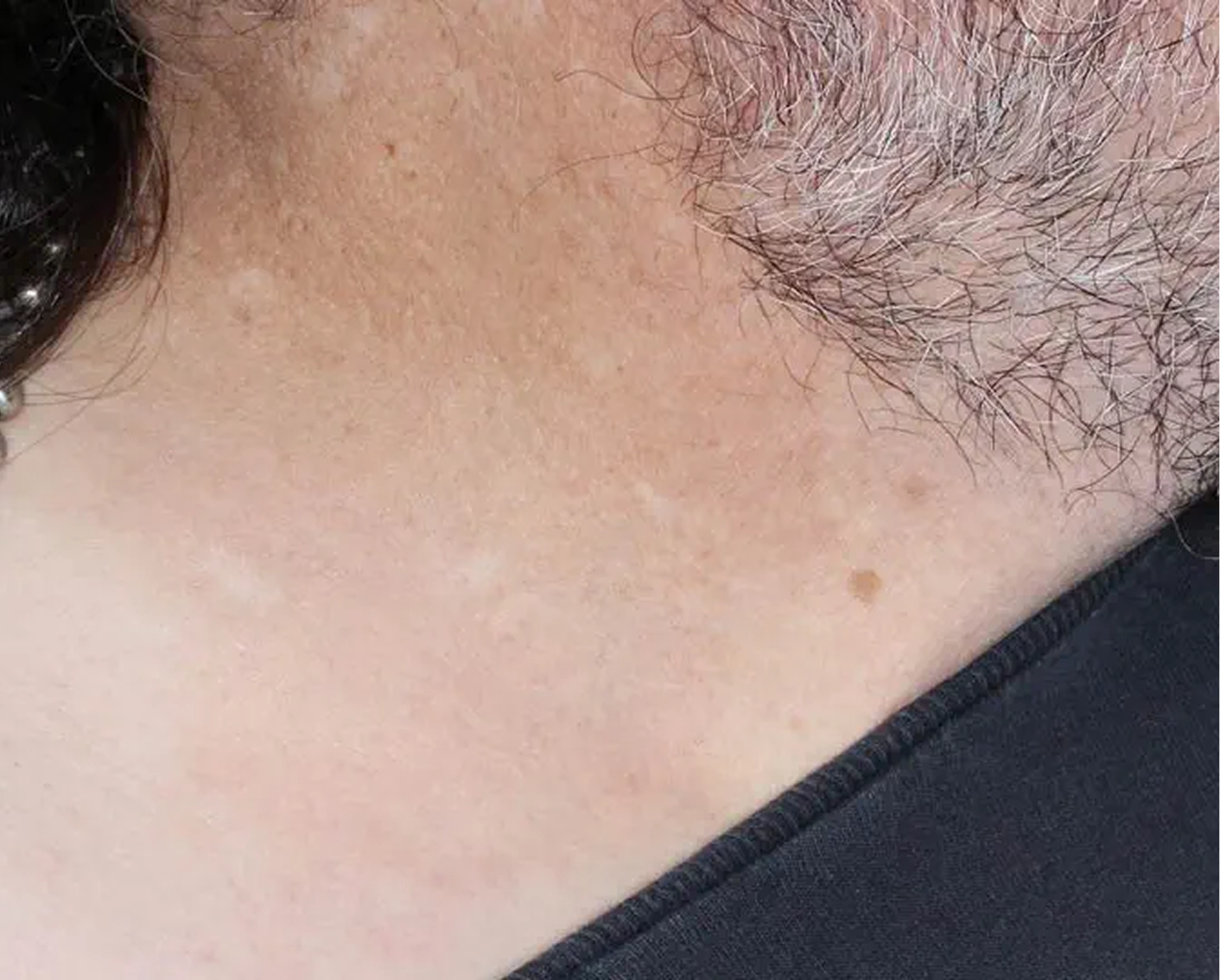 Face & Neck - Week 8 IGA = 1