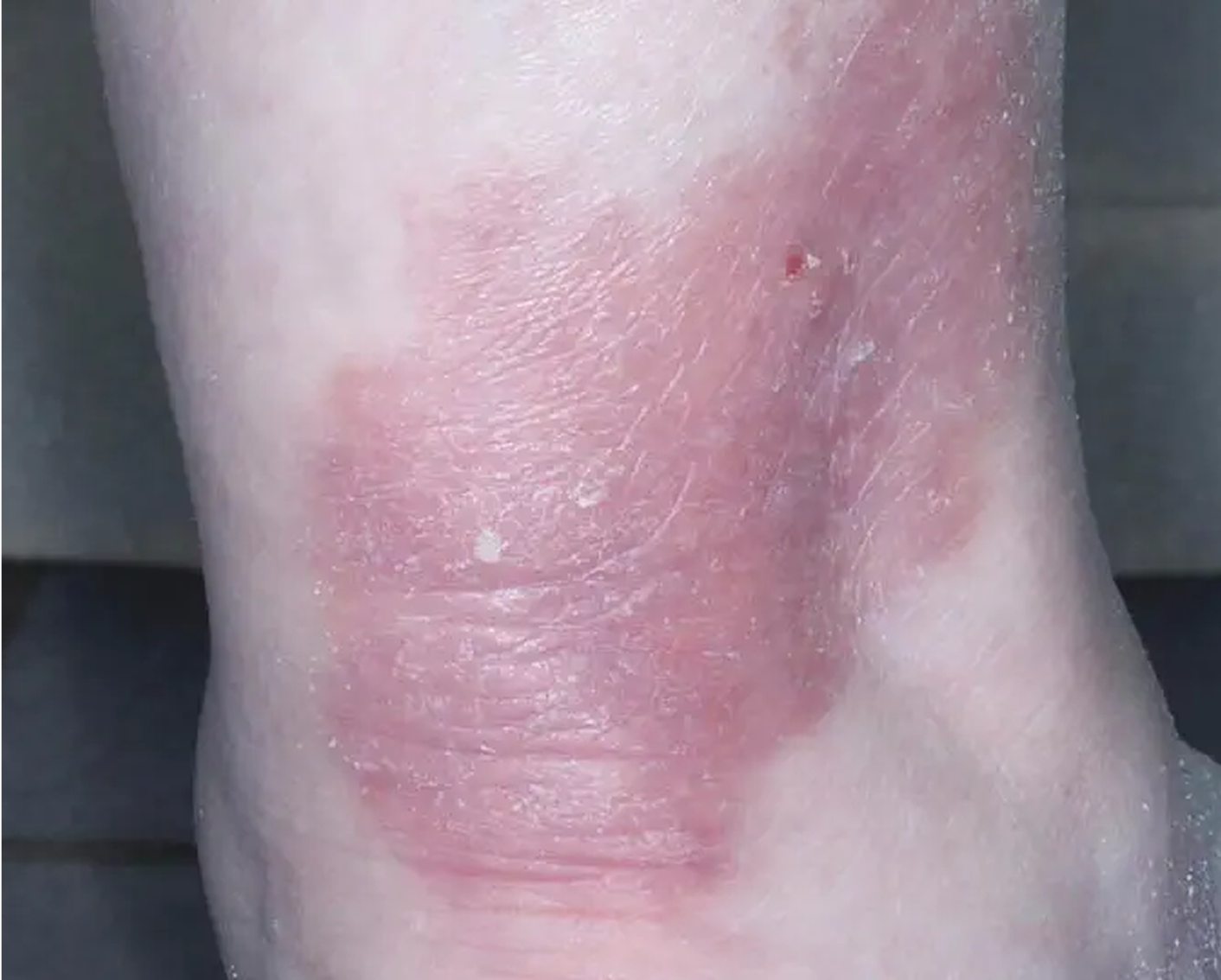 Heel - Week 2 IGA = 1
