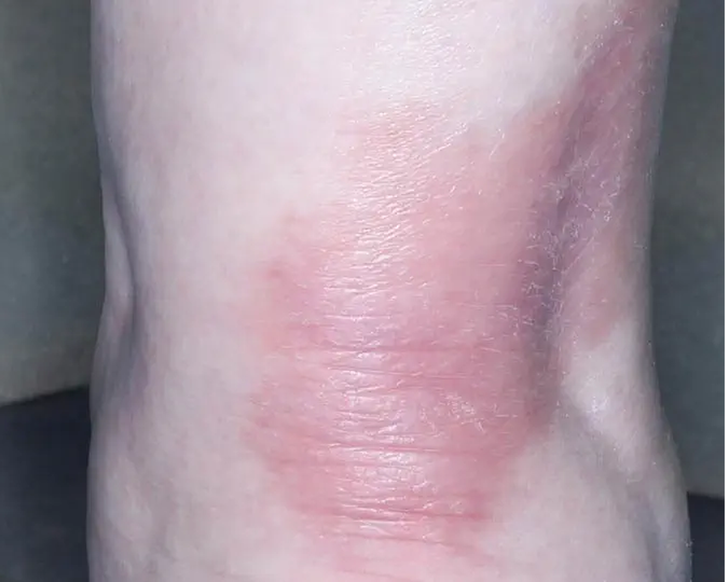 Heel - Week 4 IGA = 1