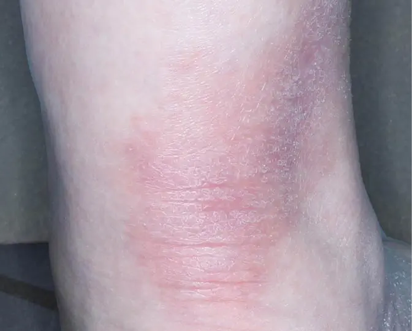 Heel - Week 6 IGA = 0