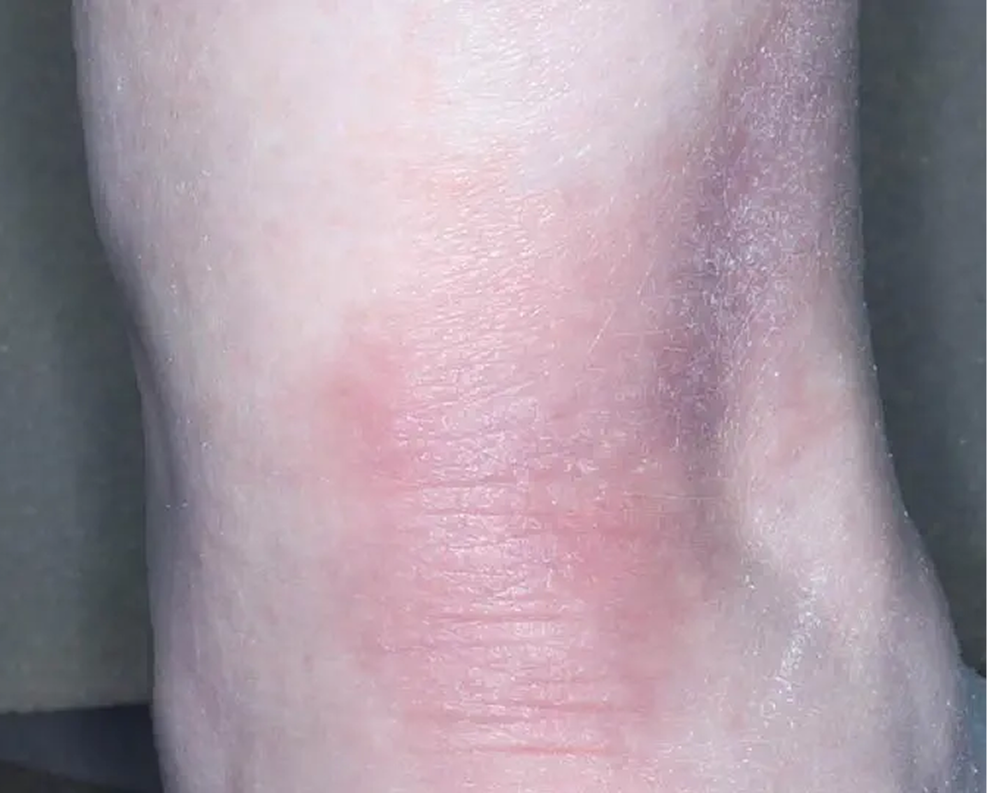 Heel - Week 8 IGA = 1