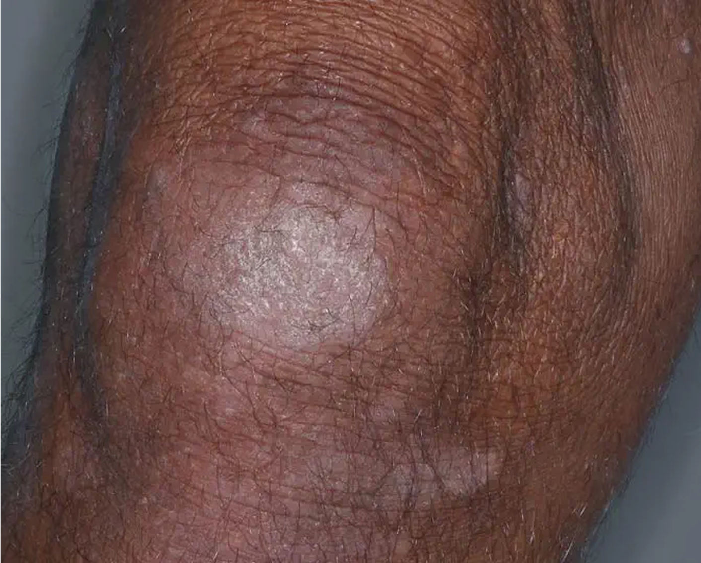 Knee - Week 8 IGA = 2