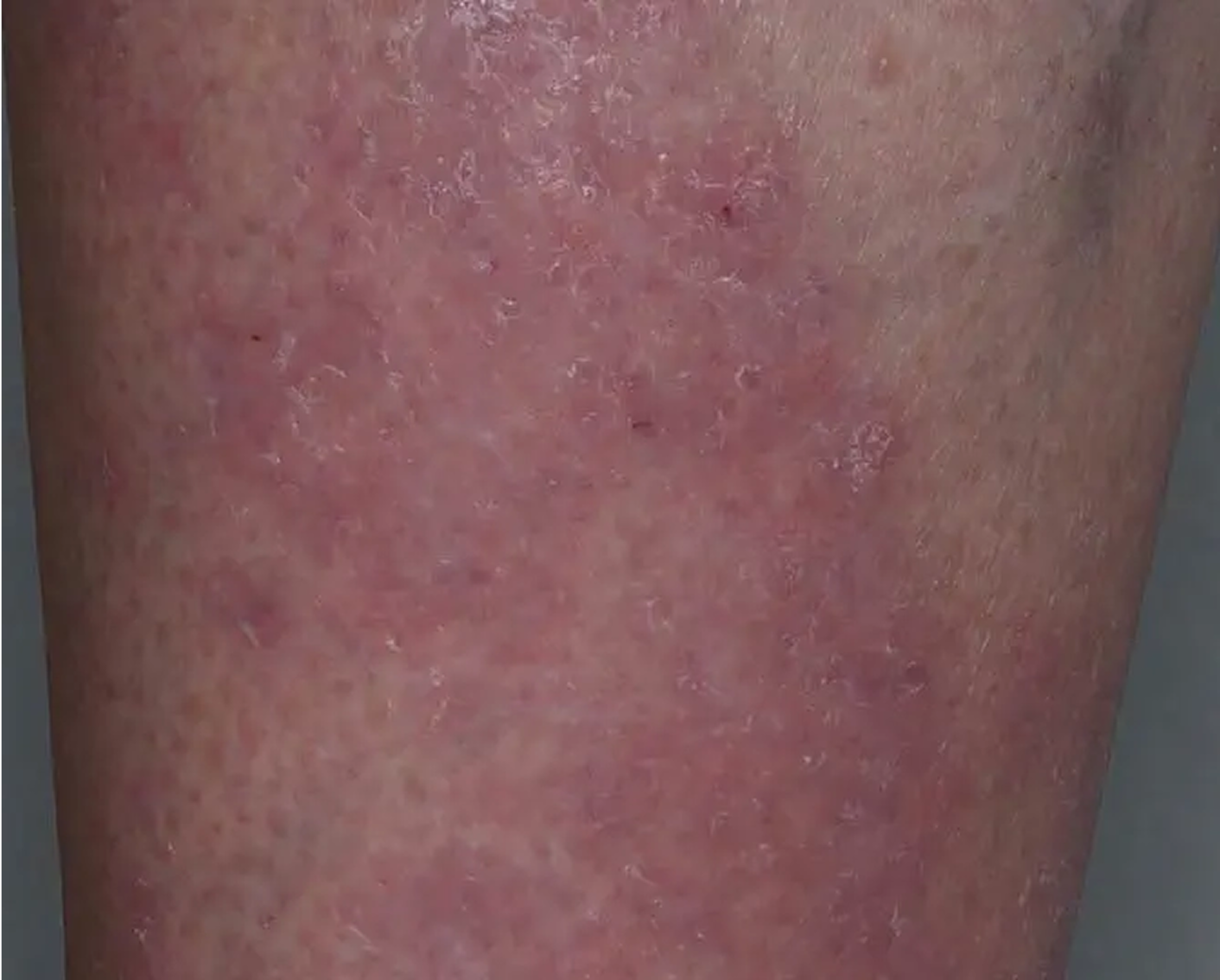 Shin - Week 2 IGA = 2