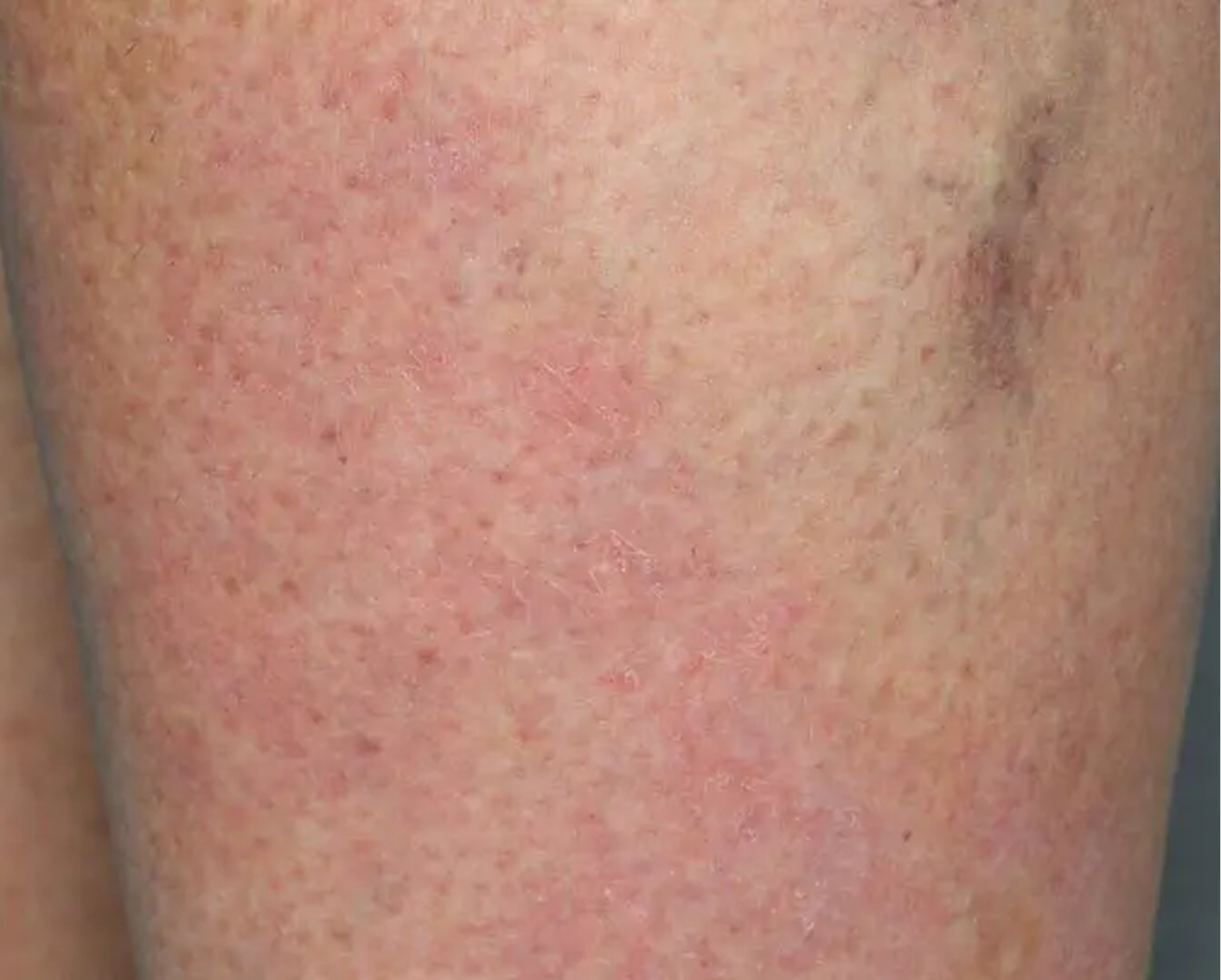 Shin - Week 6 IGA = 0