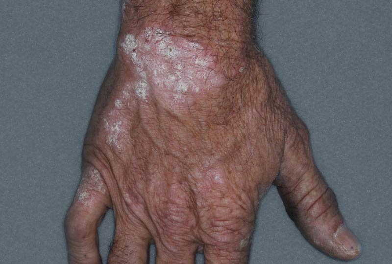 Hand before treatment - Baseline IGA = 4