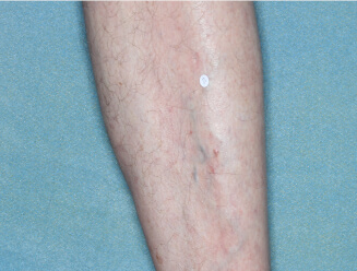 Image of leg at week 8
