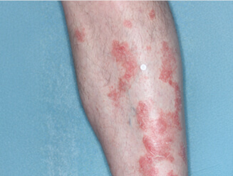 Image of leg at baseline