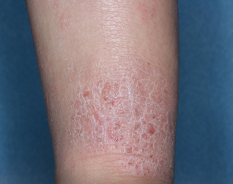 Ankle with atopic dermatitis before treatment - Baseline vIGA-AD = 3