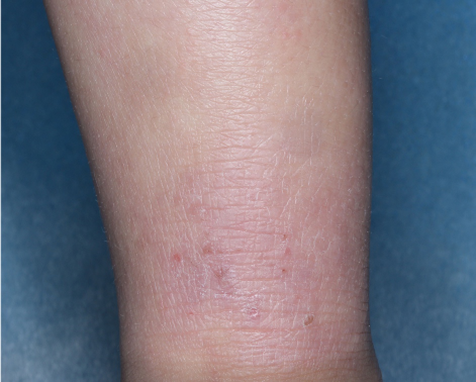 Ankle with atopic dermatitis on Week 1 of treatment - vIGA-AD = 2