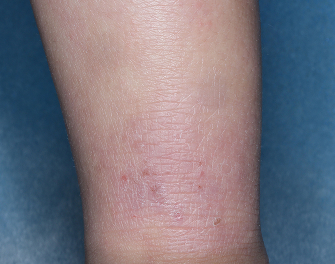 Ankle with atopic dermatitis on Week 1 of treatment - vIGA-AD = 2