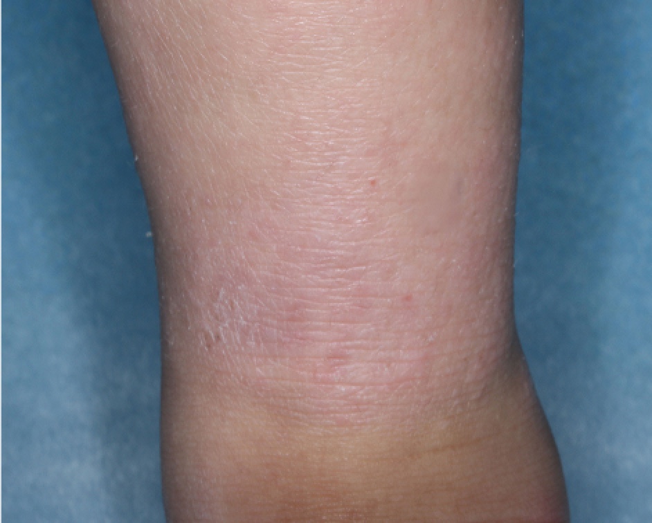 Ankle with atopic dermatitis on Week 4 of treatment - vIGA-AD = 1