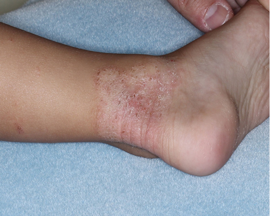 Ankle1 with atopic dermatitis before treatment - Baseline vIGA-AD = 3