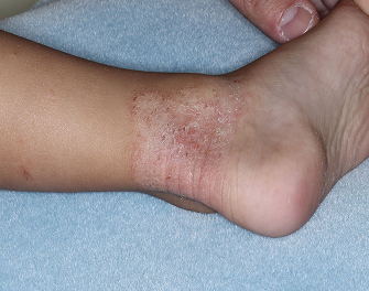 Ankle1 with atopic dermatitis before treatment - Baseline vIGA-AD = 3