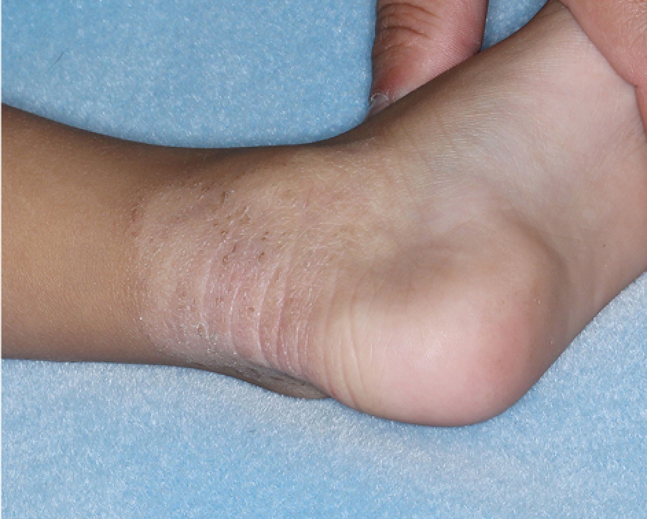Ankle1 with atopic dermatitis on Week 1 of treatment - vIGA-AD = 1