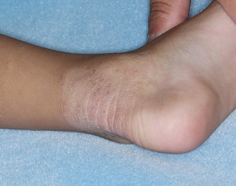 Ankle1 with atopic dermatitis on Week 1 of treatment - vIGA-AD = 1
