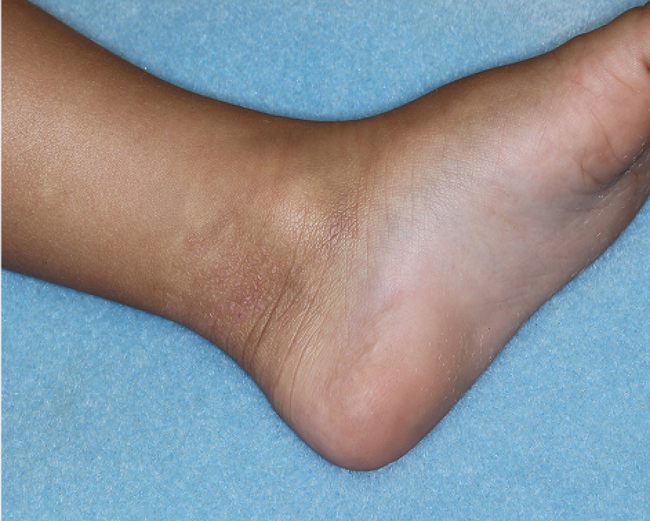 Ankle1 with atopic dermatitis on Week 4 of treatment - vIGA-AD = 1