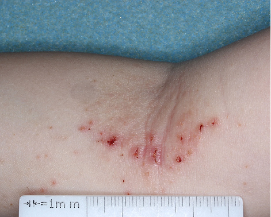 Antecubital Fossa with atopic dermatitis before treatment - Baseline vIGA-AD = 3