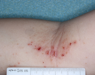 Antecubital Fossa with atopic dermatitis before treatment - Baseline vIGA-AD = 3