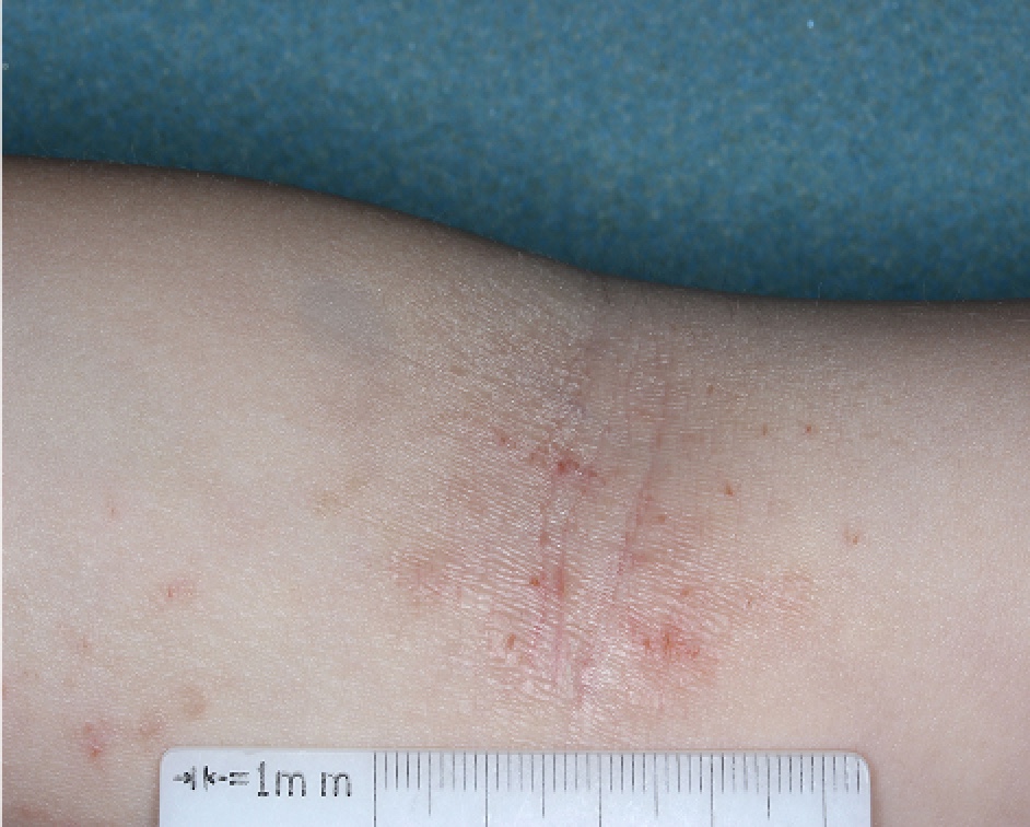 Antecubital Fossa with atopic dermatitis on Week 1 of treatment - vIGA-AD = 3