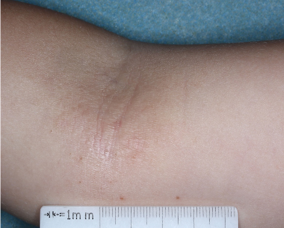 Antecubital Fossa with atopic dermatitis on Week 4 of treatment - vIGA-AD = 1