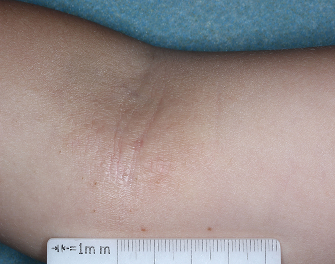 Antecubital Fossa with atopic dermatitis on Week 4 of treatment - vIGA-AD = 1