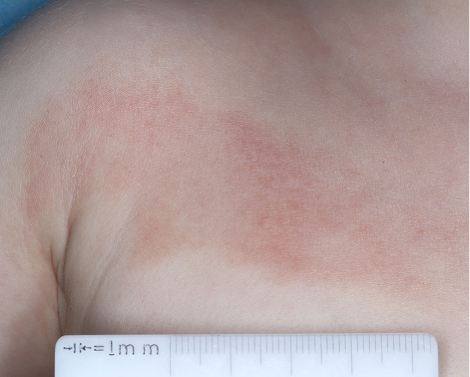 Chest with atopic dermatitis before treatment - Baseline vIGA-AD = 3