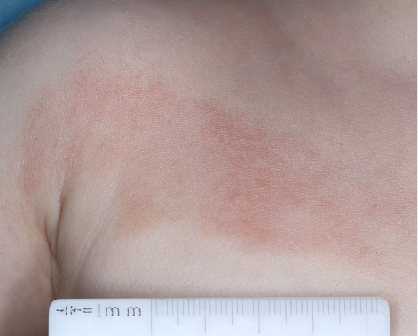 Chest with atopic dermatitis before treatment - Baseline vIGA-AD = 3