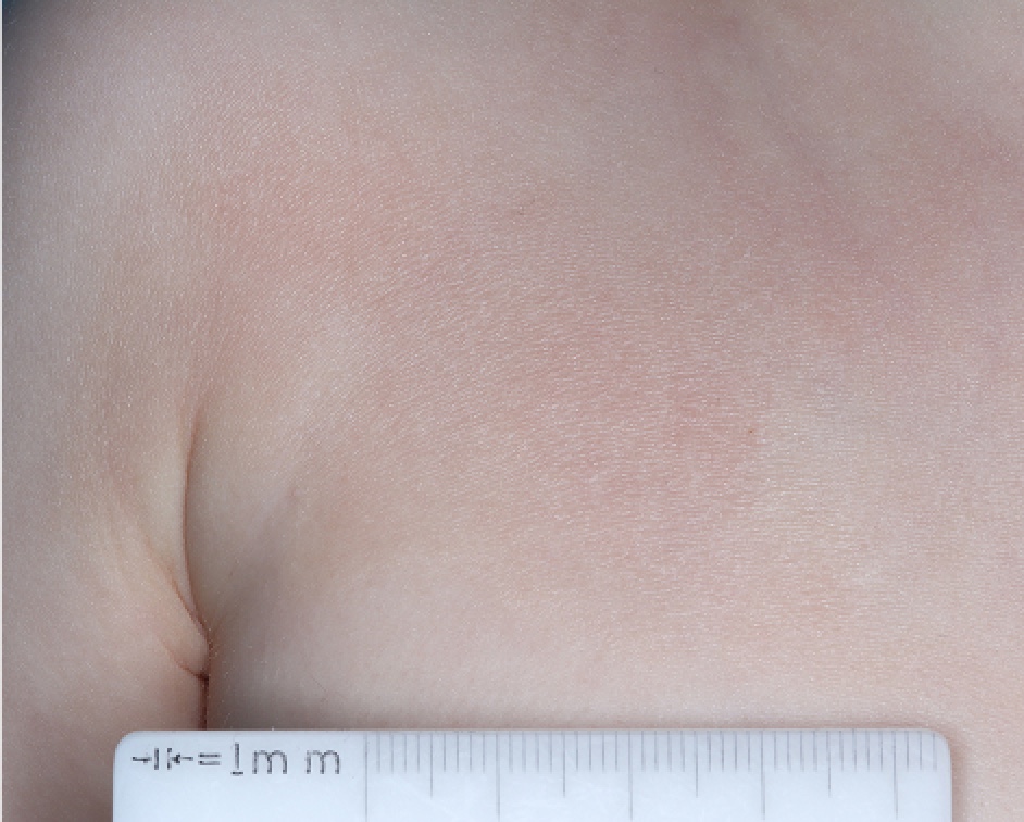 Chest with atopic dermatitis on Week 1 of treatment - vIGA-AD = 2