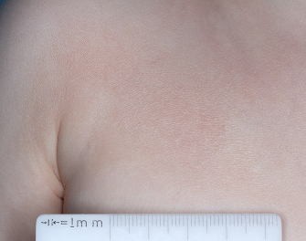 Chest with atopic dermatitis on Week 1 of treatment - vIGA-AD = 2