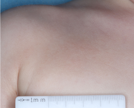 Chest with atopic dermatitis on Week 4 of treatment - vIGA-AD = 1