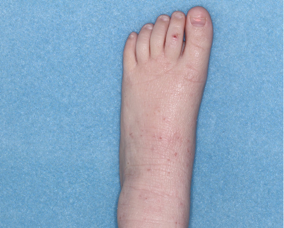 Foot with atopic dermatitis before treatment - Baseline vIGA-AD = 3