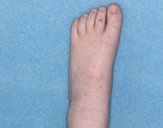 Foot with atopic dermatitis before treatment - Baseline vIGA-AD = 3