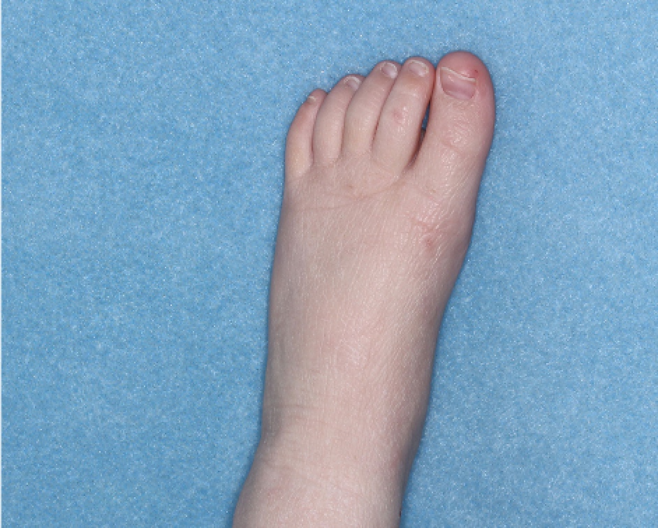 Foot with atopic dermatitis on Week 1 of treatment - vIGA-AD = 1