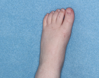 Foot with atopic dermatitis on Week 1 of treatment - vIGA-AD = 1