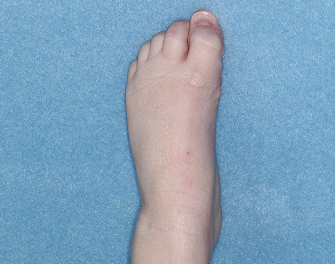 Foot with atopic dermatitis on Week 4 of treatment - vIGA-AD = 1
