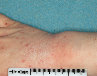 Hand and Wrist with atopic dermatitis before treatment - Baseline vIGA-AD = 3