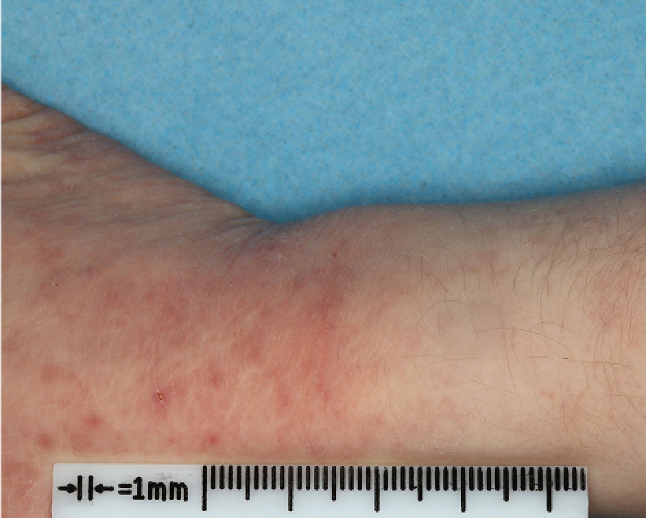 Hand and Wrist with atopic dermatitis on Week 1 of treatment - vIGA-AD = 3