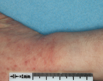 Hand and Wrist with atopic dermatitis on Week 1 of treatment - vIGA-AD = 3