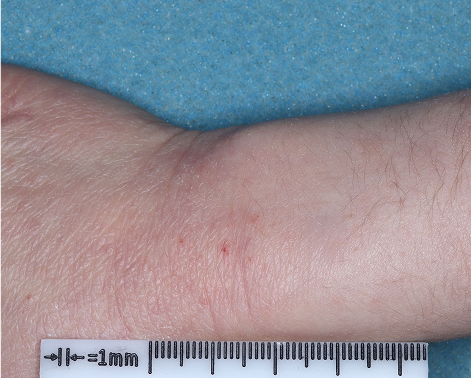 Hand and Wrist with atopic dermatitis on Week 4 of treatment - vIGA-AD = 1