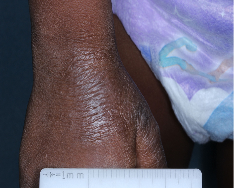Hand with atopic dermatitis before treatment - Baseline vIGA-AD = 3