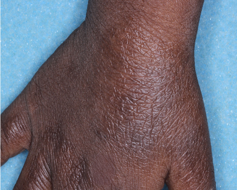 Hand with atopic dermatitis on Week 4 of treatment - vIGA-AD = 1