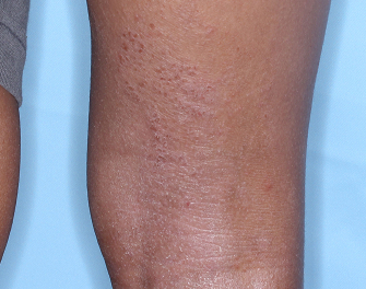 Popliteal Fossa with atopic dermatitis before treatment - Baseline vIGA-AD = 3