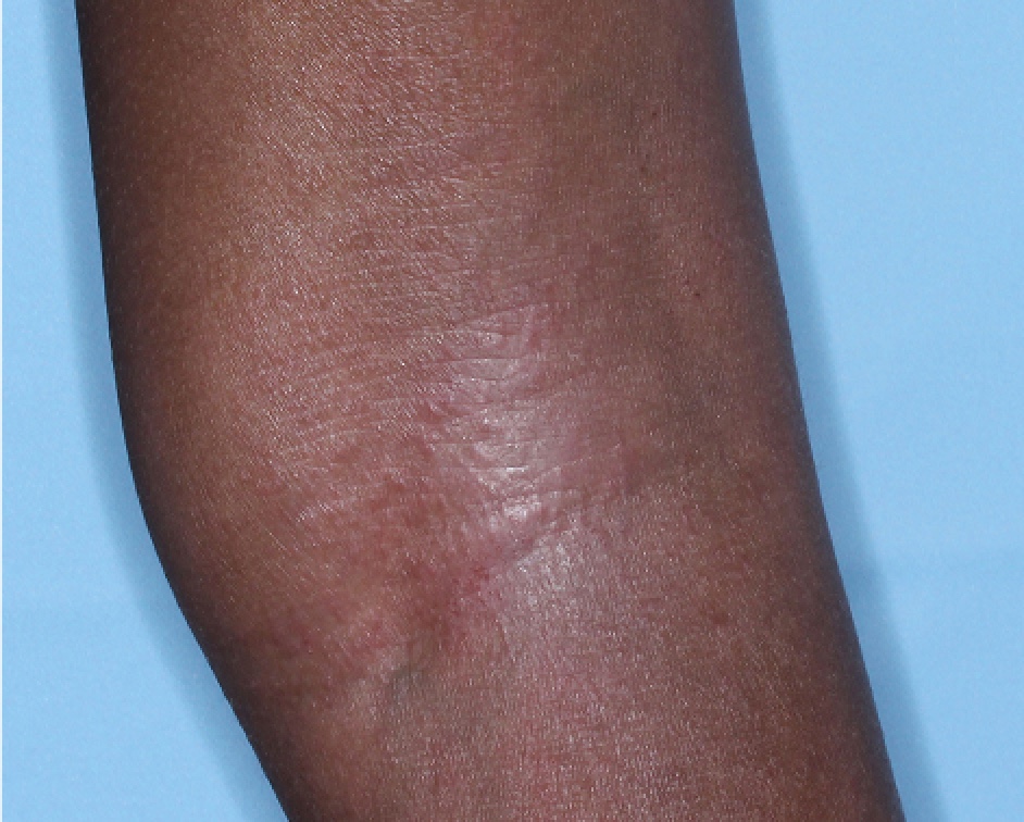 Popliteal Fossa with atopic dermatitis on Week 1 of treatment - vIGA-AD = 2