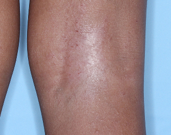 Popliteal Fossa with atopic dermatitis on Week 4 of treatment - vIGA-AD = 1